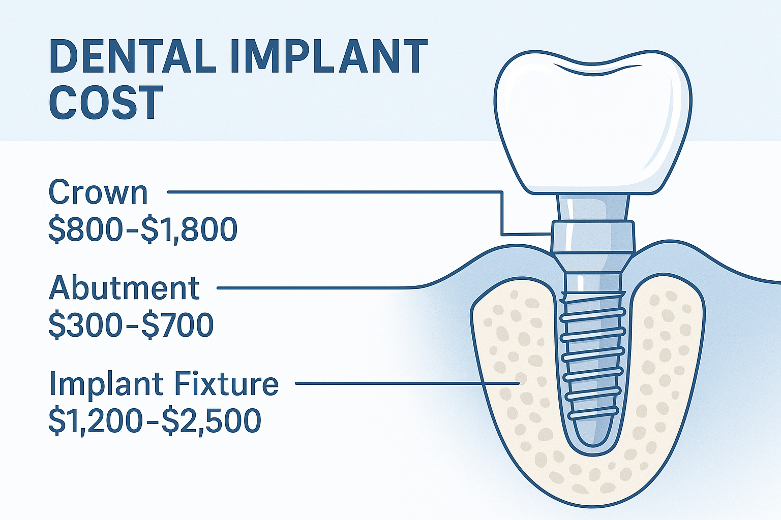 The Complete Guide to Dental Implant Costs in Dallas, TX: What You Need to Know Before Your Procedure