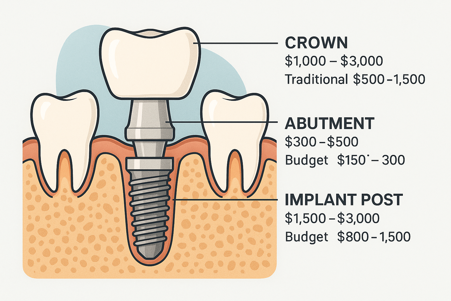 Low-Cost Dental Implants in Dallas – Are They Worth It?