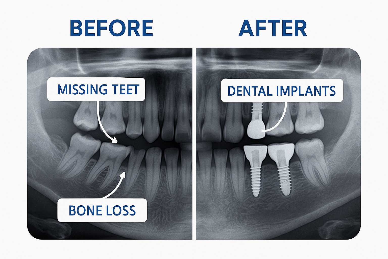 8 Signs That You Need Dental Implants: When to Consider This Life-Changing Solution