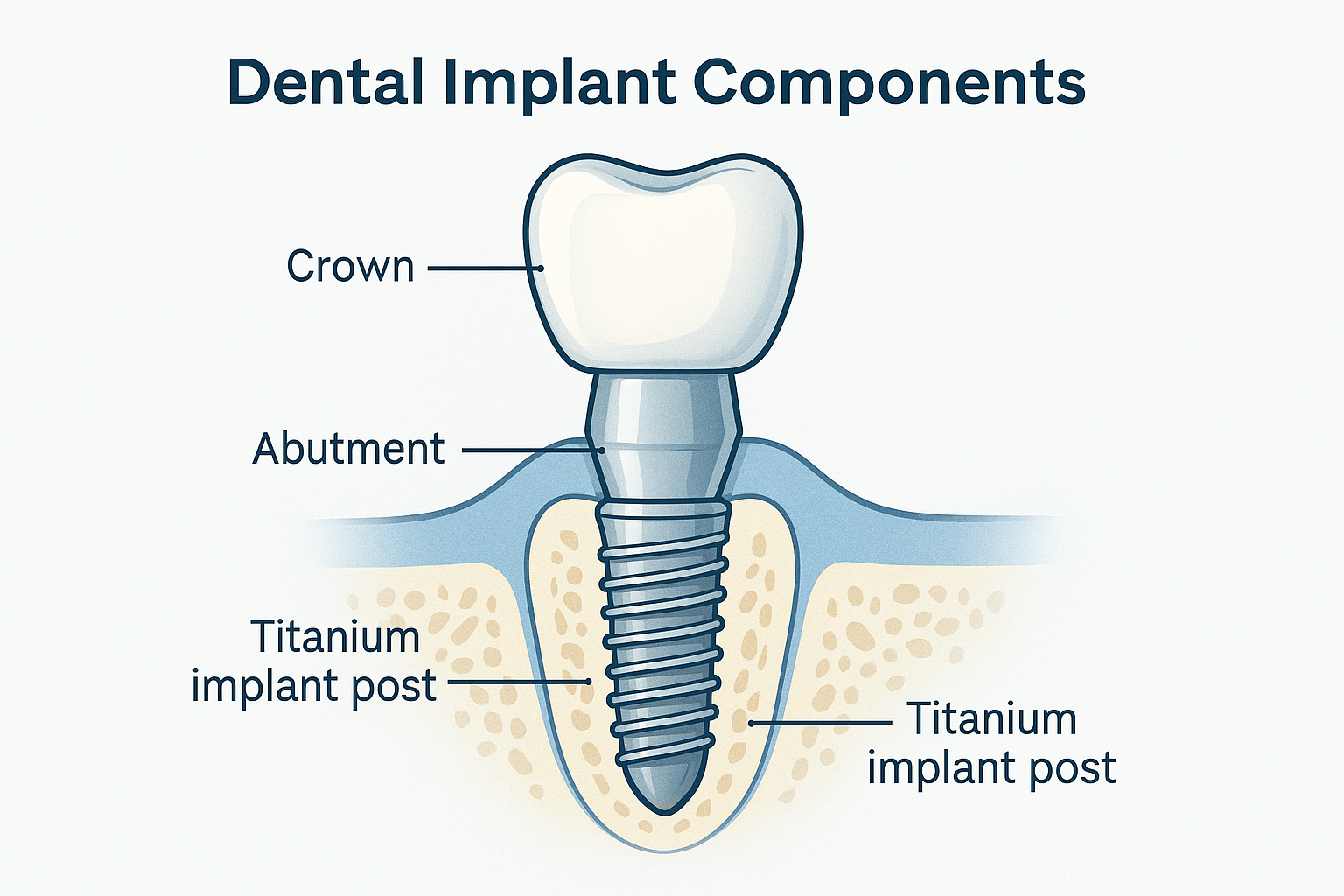Your Complete Guide to Dental Implants in Dallas, GA: Restore Your Smile with Confidence