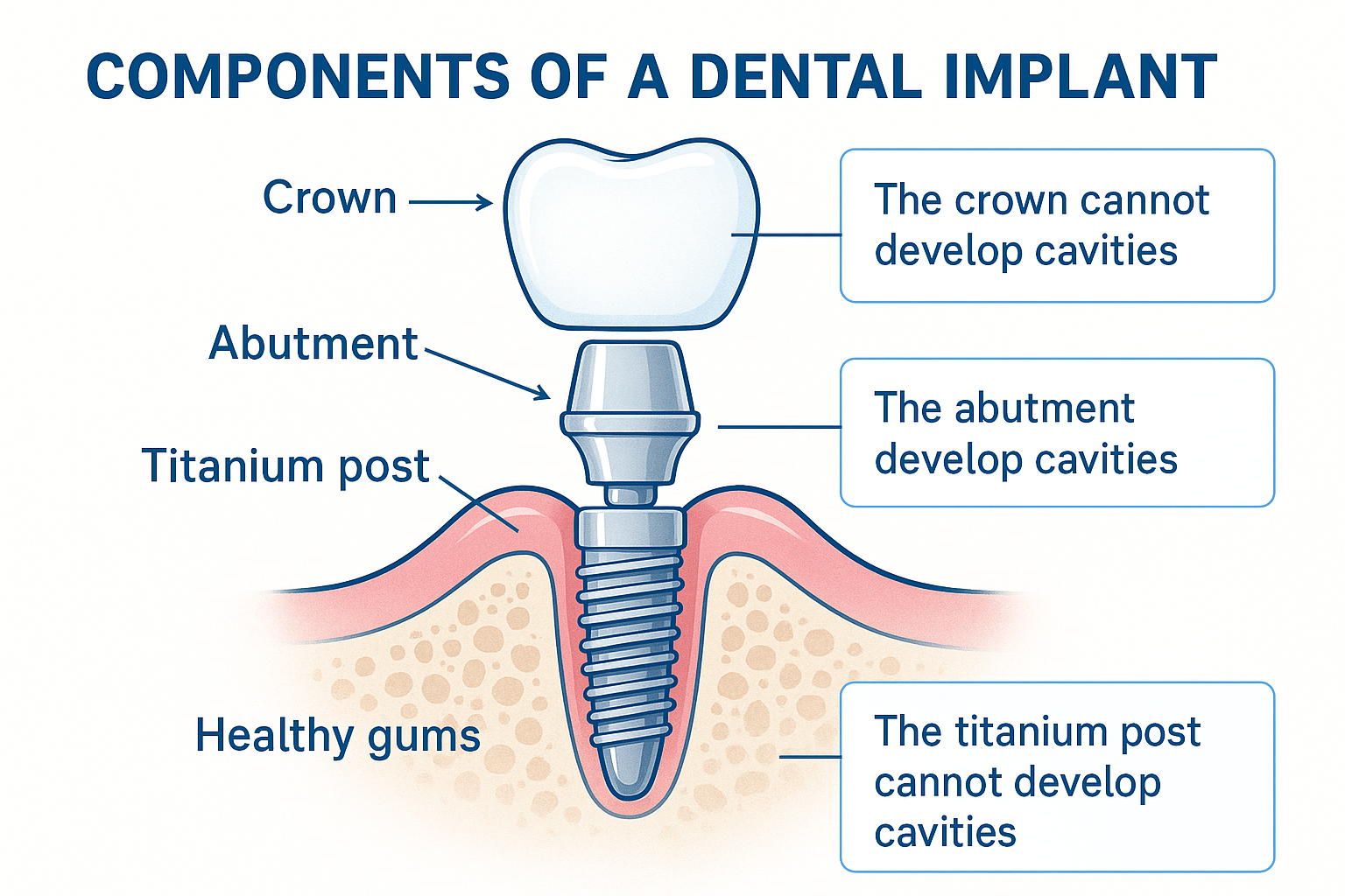 Can Dental Implants Get Cavities? Your Complete Guide to Implant Care