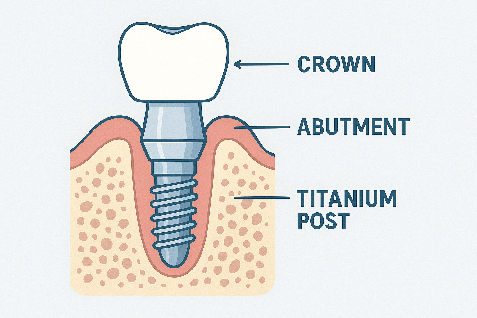 Nuvia Dental Implant Center Dallas: Your Complete Guide to Advanced Tooth Replacement Solutions