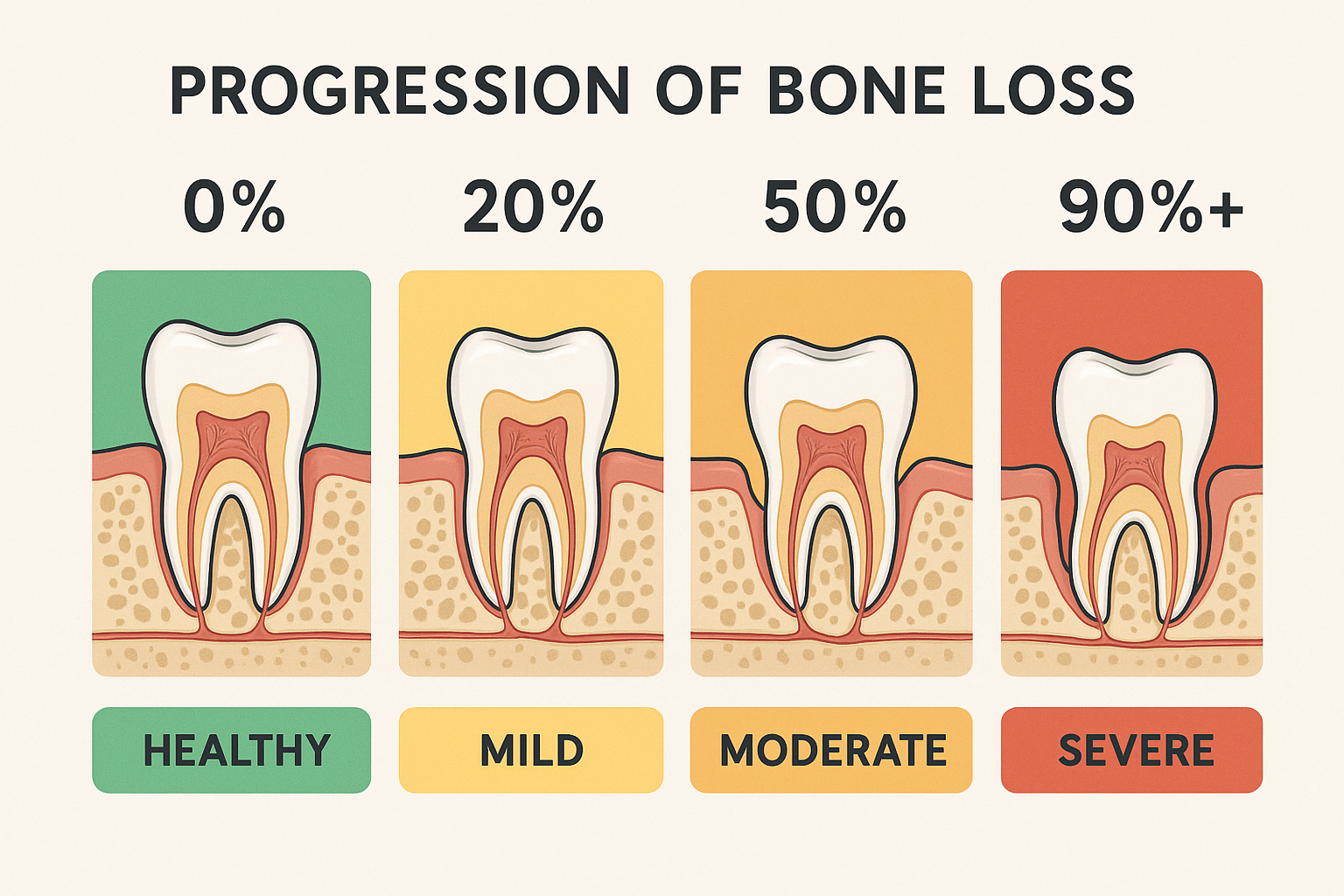 Understanding 90 Percent Bone Loss in Teeth: Your Complete Guide to Severe Bone Loss and Treatment Options