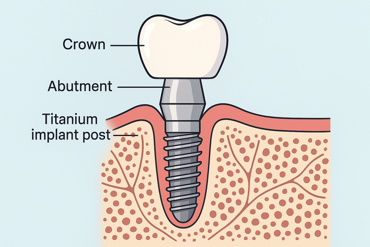 Implantes Dentales Dallas TX: Your Complete Guide to Dental Implants in Dallas