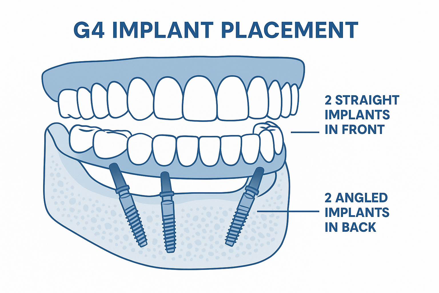 G4 Dental Implants Dallas: Your Complete Guide to Life-Changing Smile Restoration in 2025