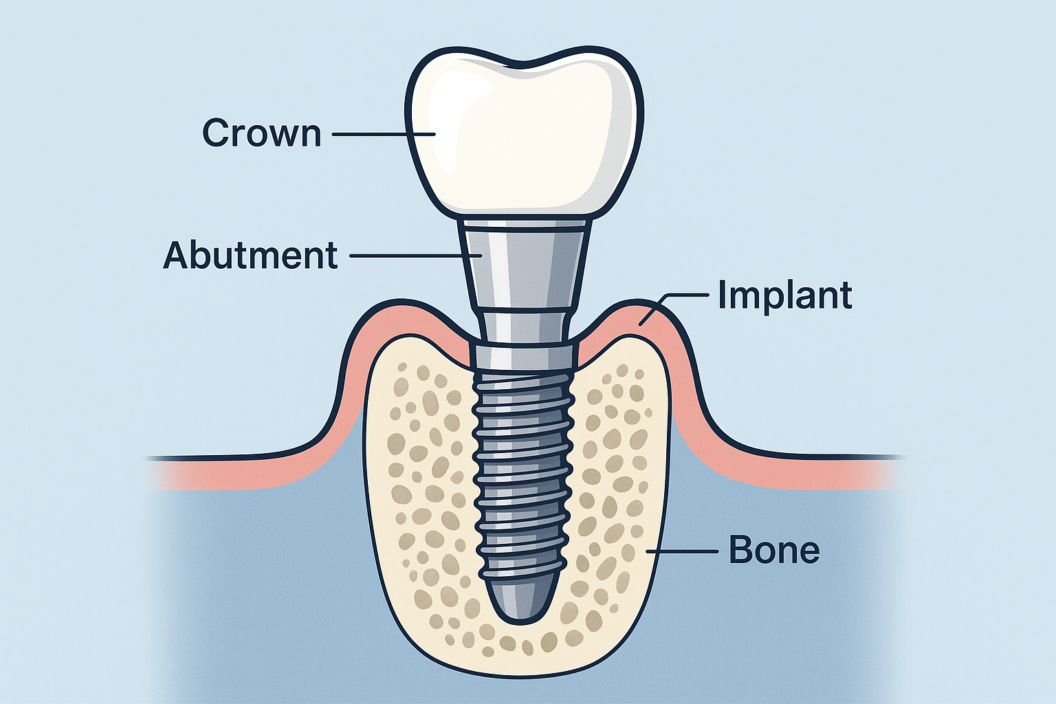 How Long Does a Dental Implant Take? A Complete Timeline Guide for 2025