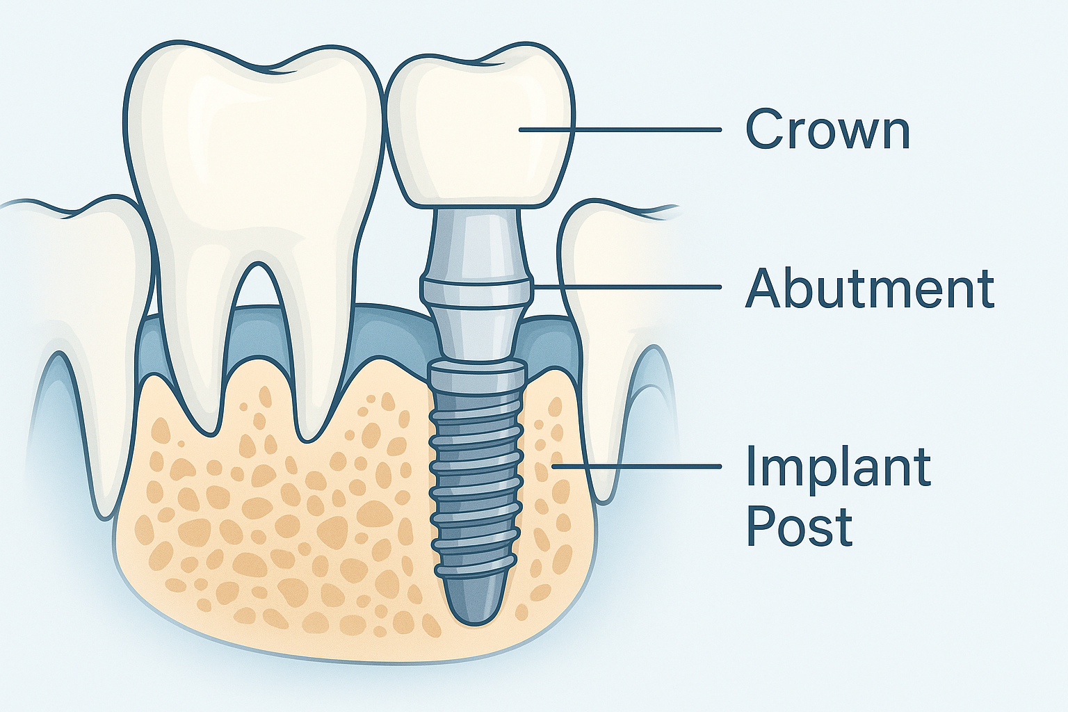 Dental Implants in Dallas, TX – Costs, Procedure, and Top Specialists