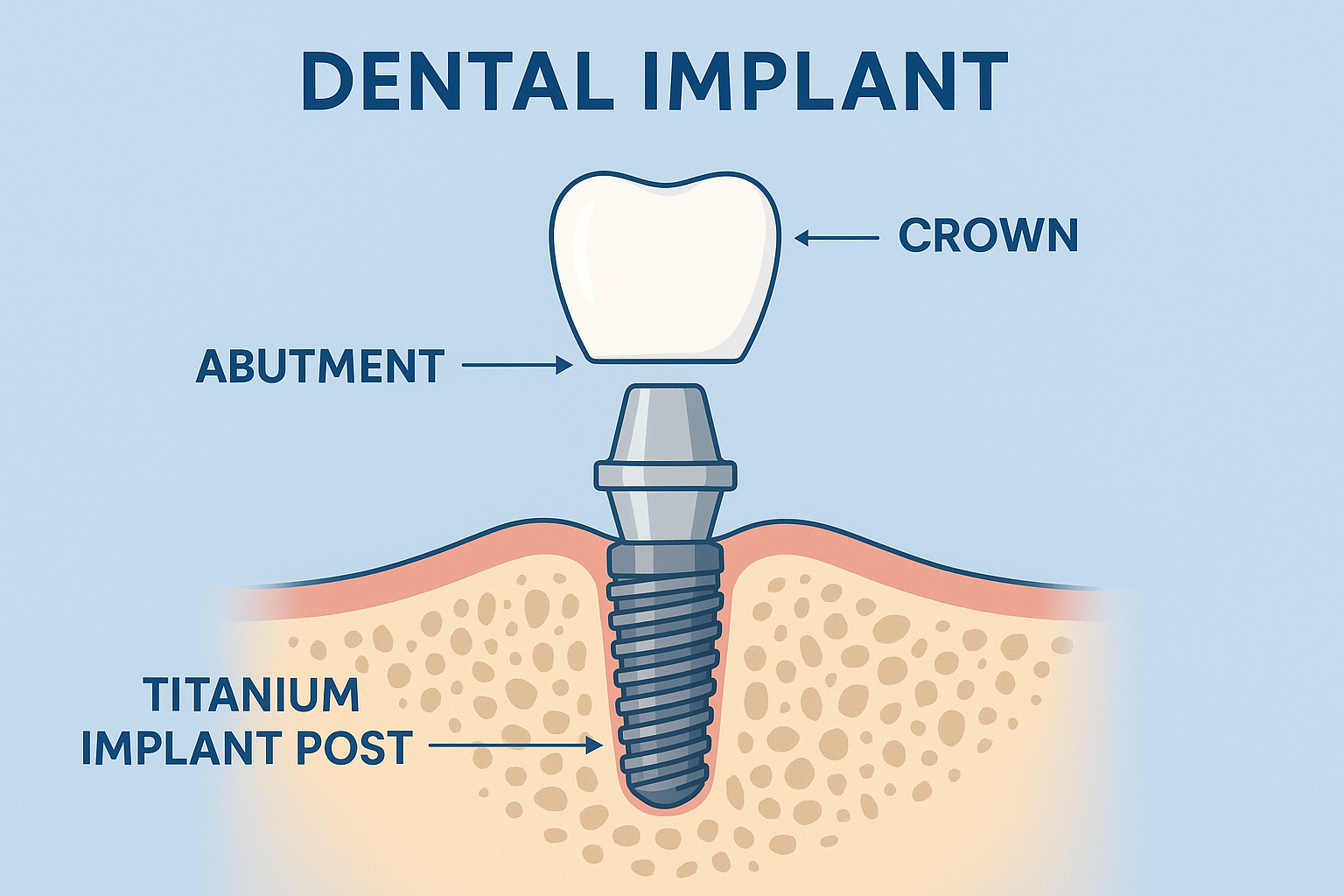 Dental Implants for Missing Teeth: Your Complete Guide to a Confident Smile in 2025