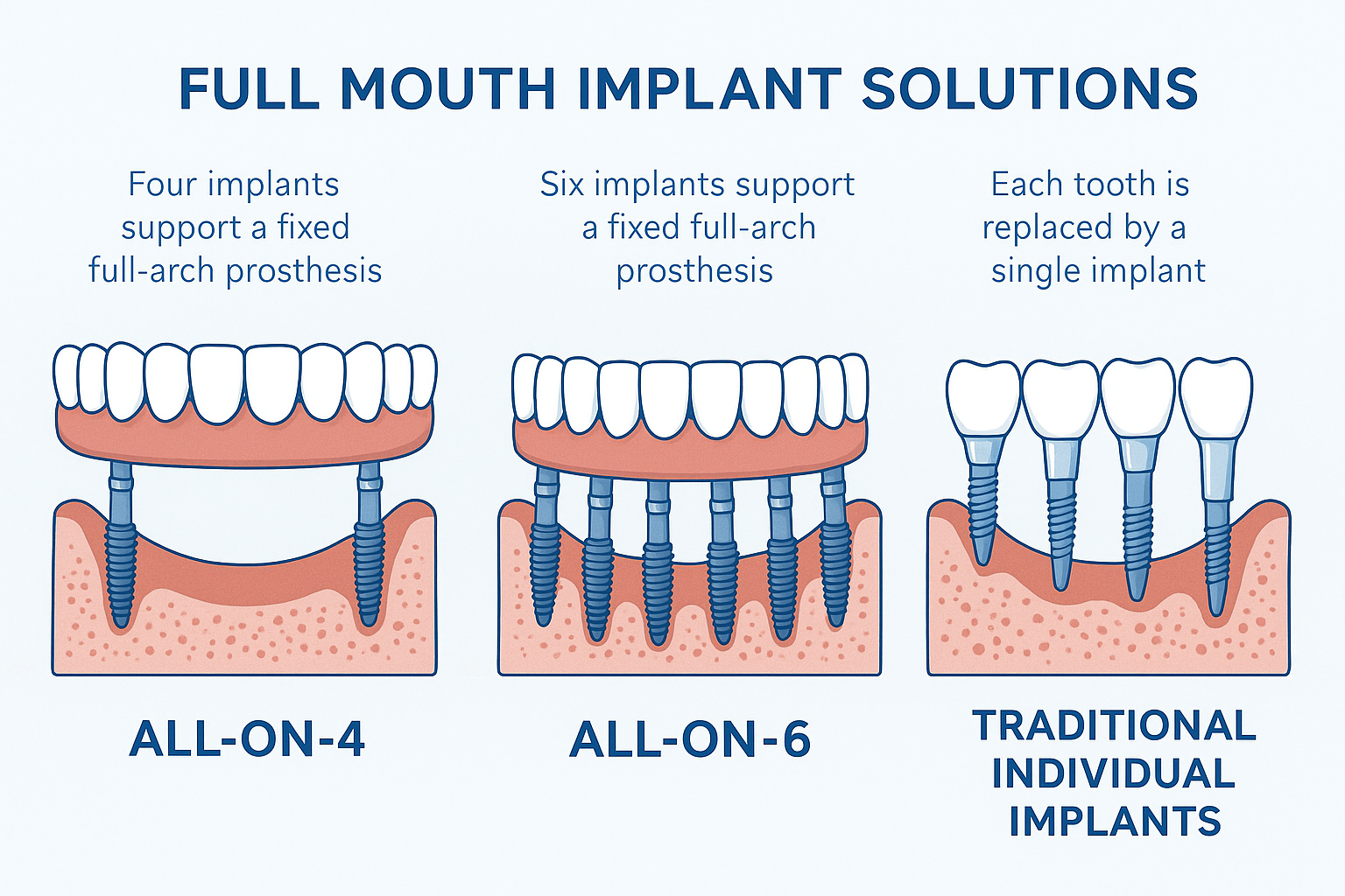 Full Mouth Implant Specialist Near Me: Your Complete Guide to Life-Changing Smile Restoration