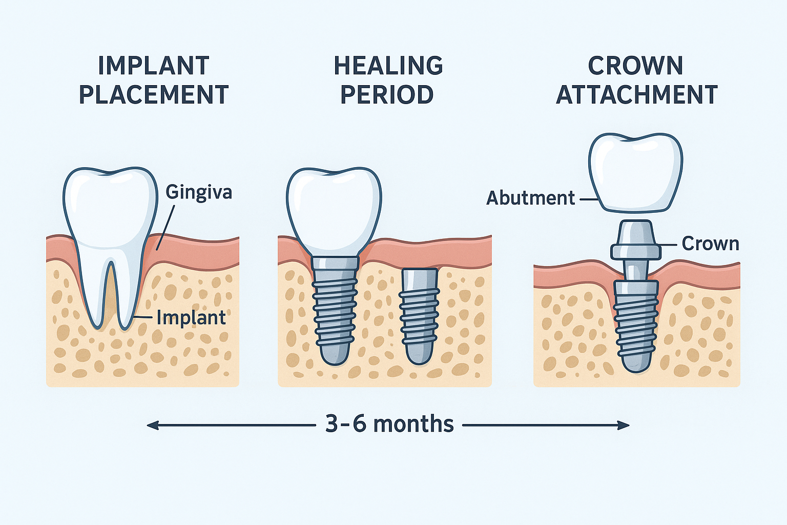Cheap Dental Implants in Dallas