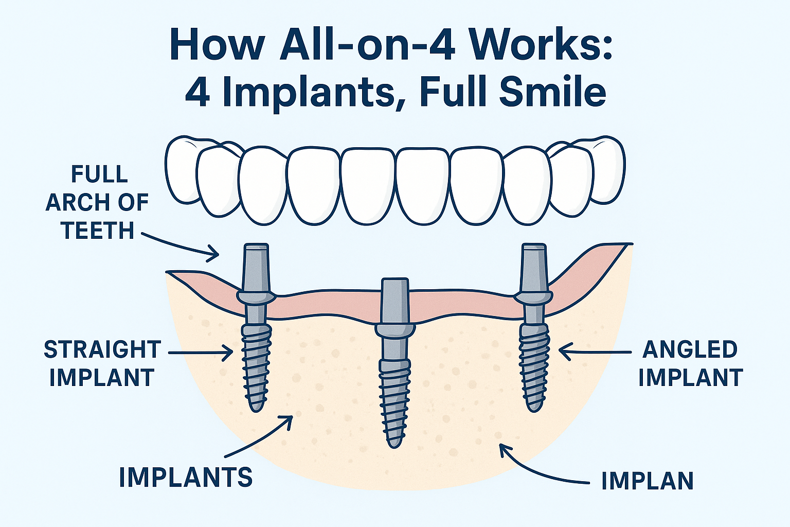 Affordable All-on-4 Dental Implants: Your Complete Guide to Life-Changing Smile Restoration in 2025