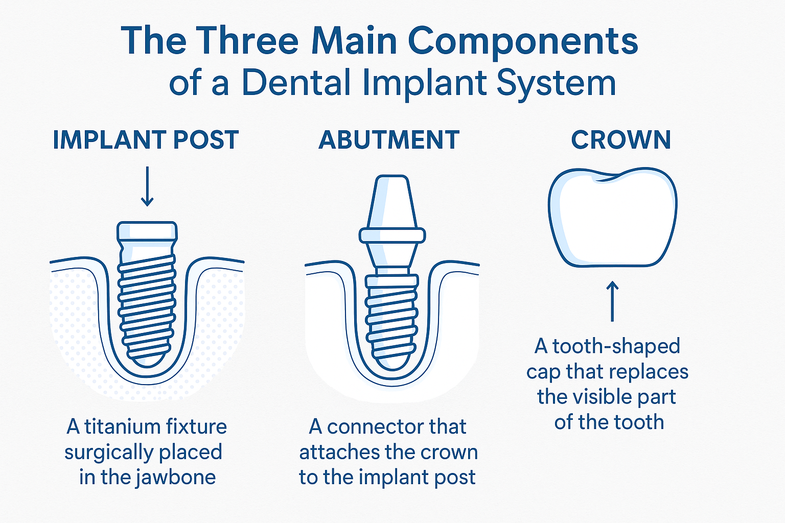 Complete Guide to Dental Implant Repairs NJ: When Your Implant Needs Professional Restoration