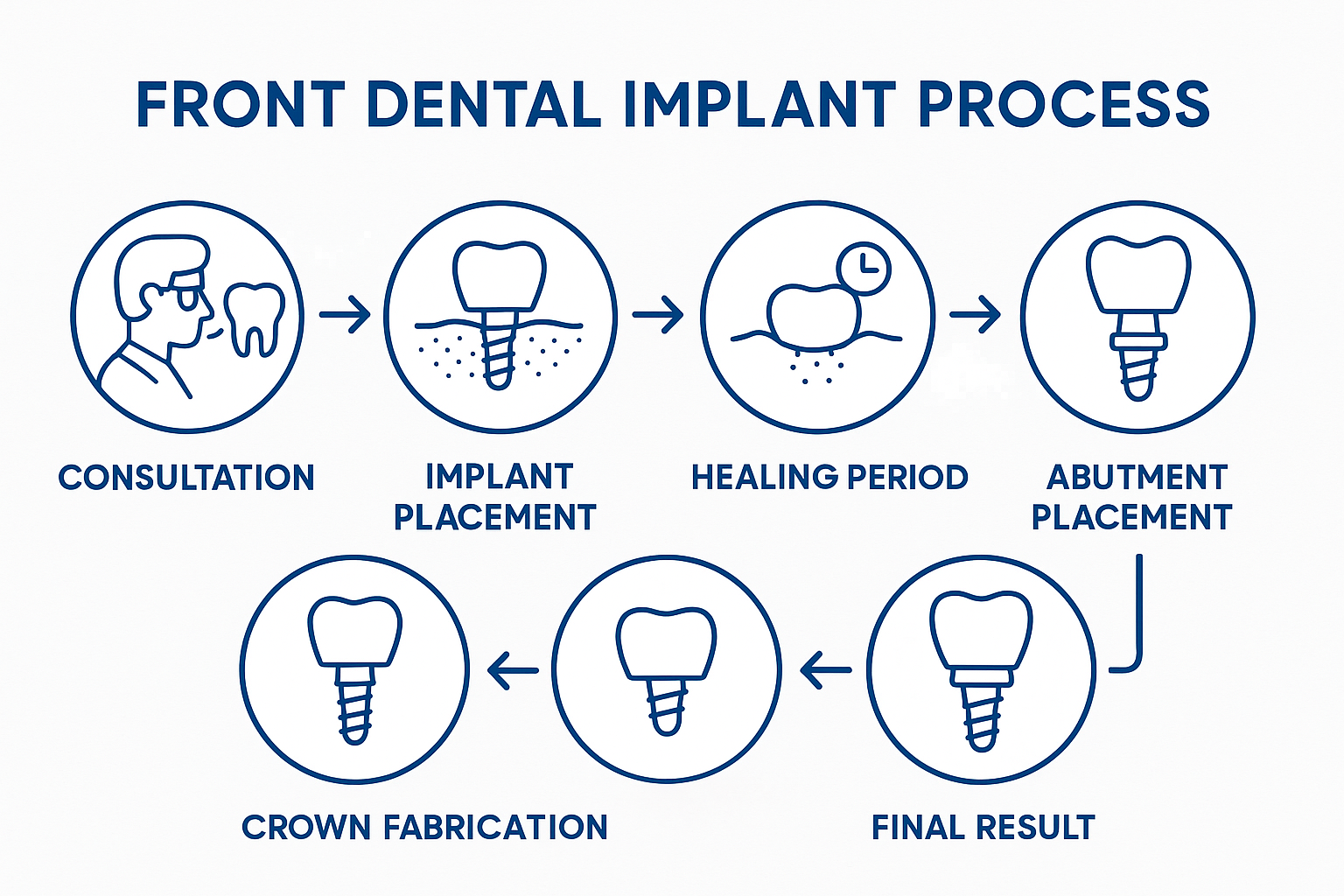 Front Dental Implants: Your Complete Guide to Restoring Your Beautiful Smile