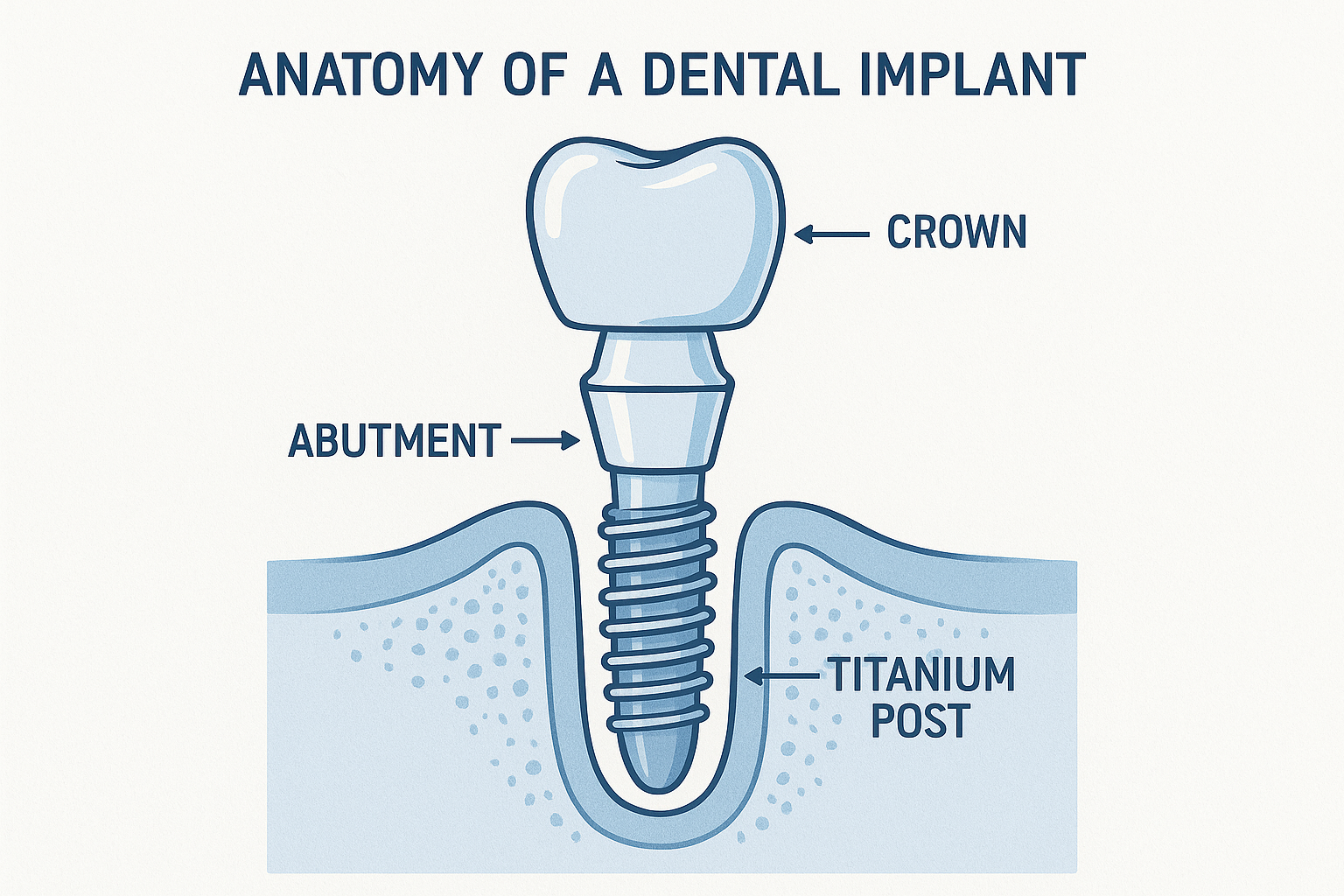 Dental Implant vs Crown: Which Is the Right Choice for Your Smile?