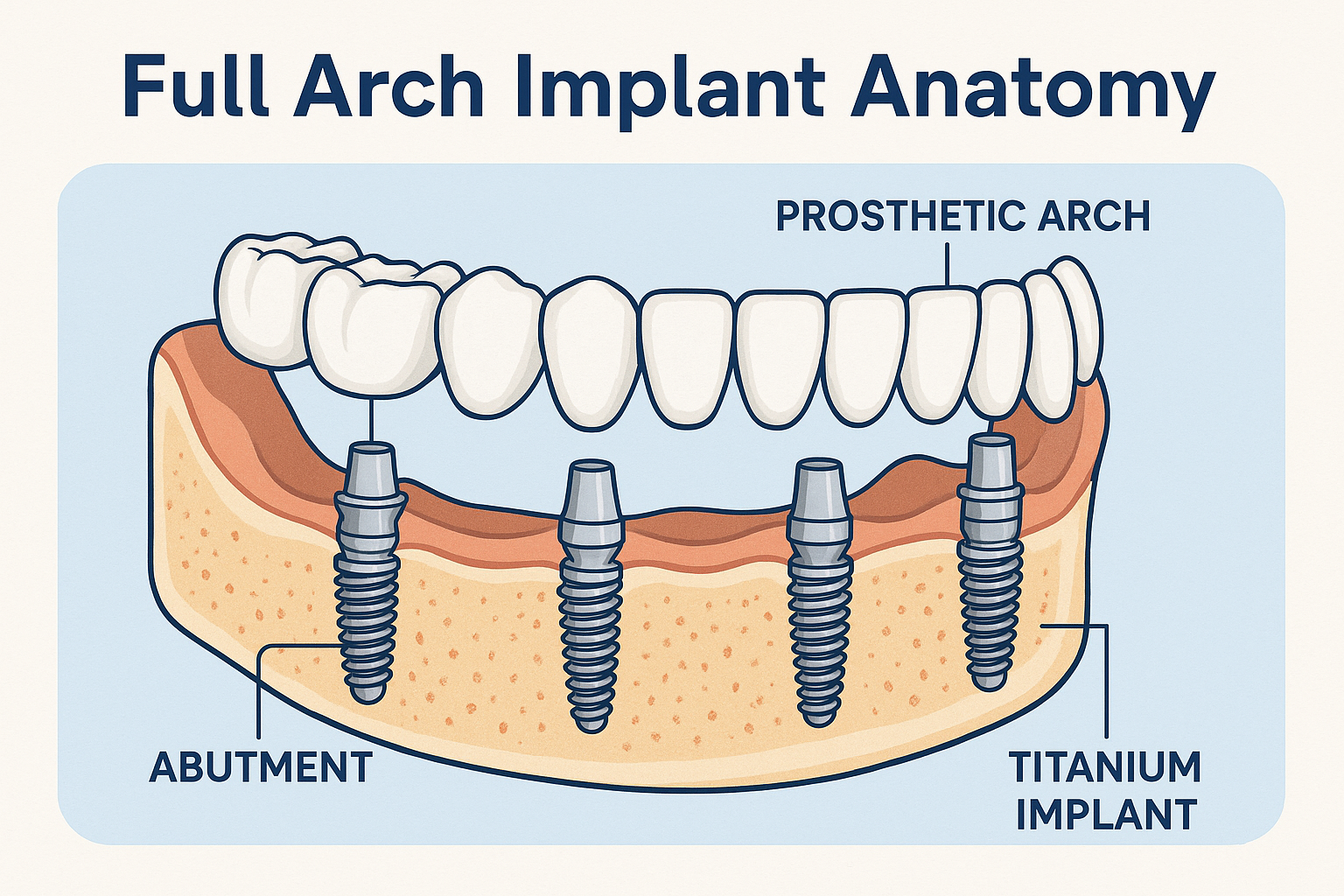 What is an Arch in Dental Implants? Your Complete Guide to Full-Mouth Restoration