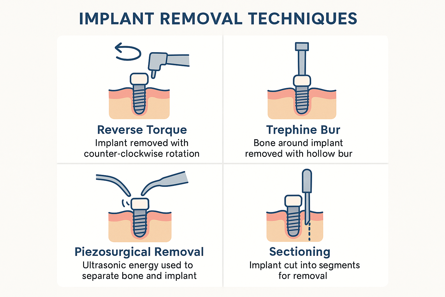 When Dental Implants Fail: A Complete Guide to Dental Implant Removal
