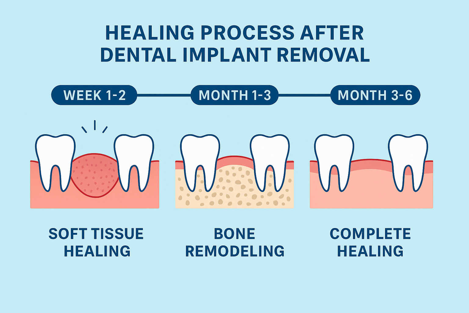 When Dental Implants Fail: A Complete Guide to Dental Implant Removal